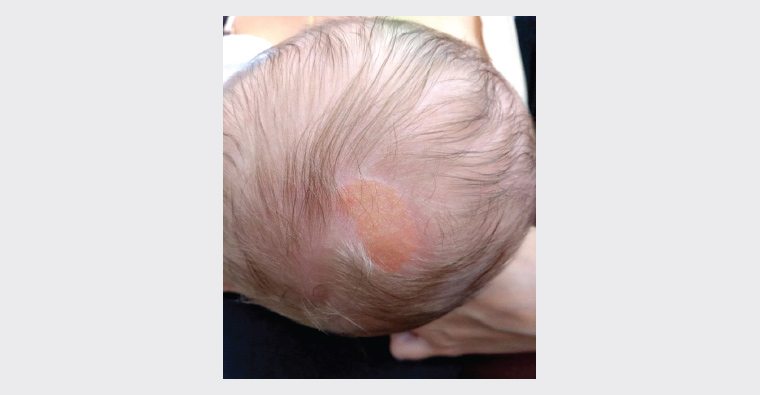 Figure 1. Macroscopic image of scalp lesion