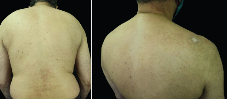 Figure 2. Photographs obtained post treatment demonstrating near-complete resolution. The dressing on the upper right shoulder is the biopsy site.