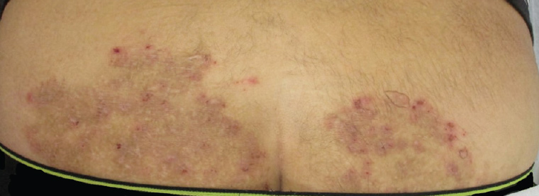 Figure 1. A representative area of involvement, with a large, hyperpigmented, excoriated and somewhat atrophic patch on the patient’s lower back and buttocks
