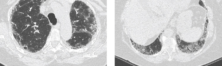Figure 1. Computed tomography images of the lungs demonstrating peripheral reticular opacification, which involves the upper (image on left) and lower lobes (image on right) with a slight basal predominance. There is honeycombing present and minimal ground glass changes.