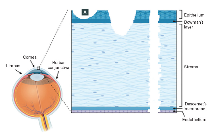 Figure 1. Schematic showing corneal layers and injuries