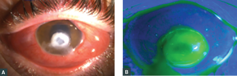 Figure 2. The left eye of a man aged 19 years with Pseudomonas spp. keratitis and visual acuity perception of light