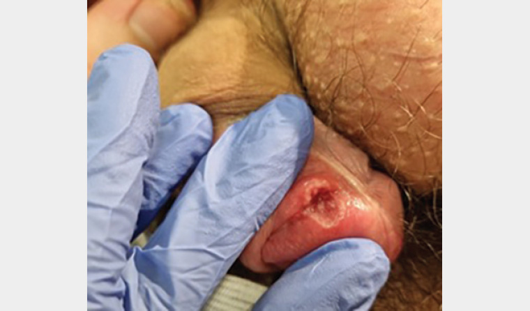 RACGP Genital ulcers