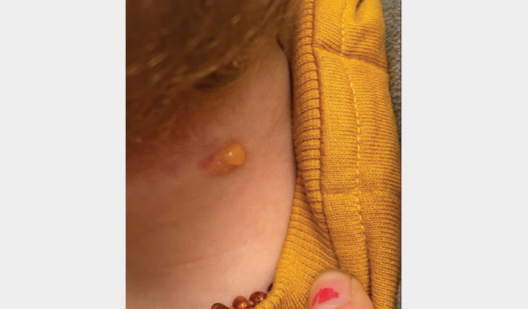 Figure 1. A blistering episode: photograph captured by the patient’s mother, showing a blister overlying the lesion on the posterior neck