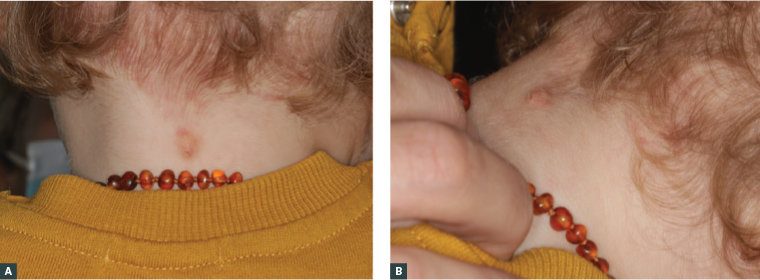 Figure 2. A solitary, mildly scaly, yellow plaque located in the midline on the posterior neck