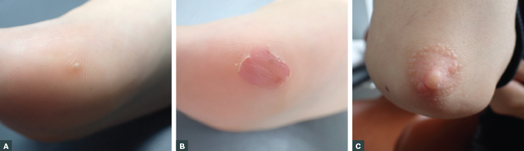 Figure 1. Cryotherapy for the treatment of cutaneous warts