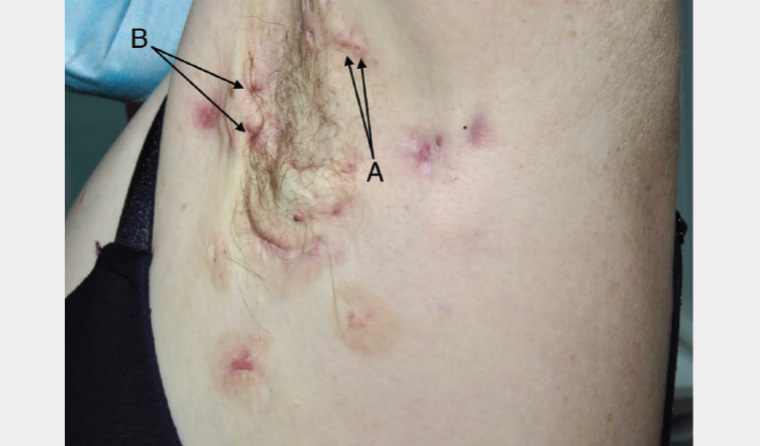 Figure 1. Hidradenitis suppurativa to the left axilla demonstrating Hurley Stage 2.
