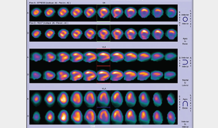 Figure 2. Myocardial perfusion scan showing fixed ischaemic mural changes