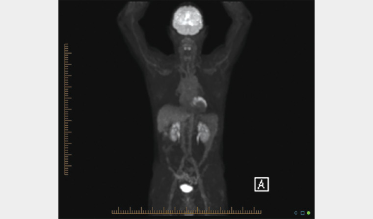 Figure 3. Positron emission tomography–computed tomography scan showing chronic myocardial ischaemia