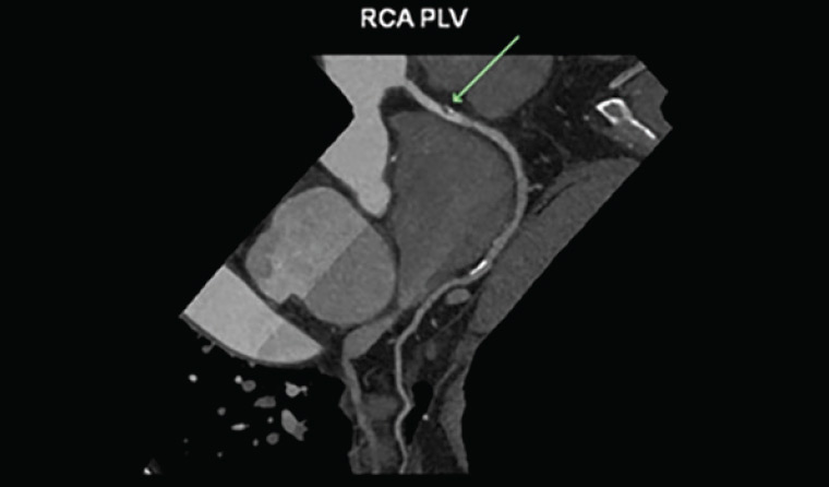 Figure 4. Soft mild <50%25 right coronary artery stenosis on computed tomography coronary angiogram (arrow)