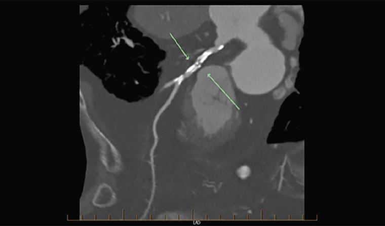 Figure 5. Gross coronary artery calcification obscuring detail (arrows)