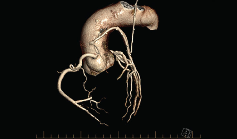 Figure 6. Three-dimensional graft study generated from computed tomography coronary angiogram