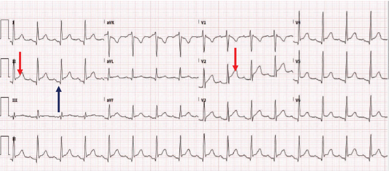 Figure 1. Electrocardiography shows sinus rhythm with diffuse ST elevation (red arrow) in most leads, except in aVR with PR depression (black arrow) when the patient was referred to the local hospital emergency department.