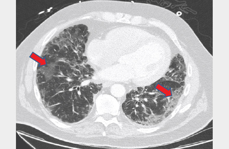 Figure 2. A computed tomography scan of the chest revealing bibasal reticular lung markings and opacities (red arrows)