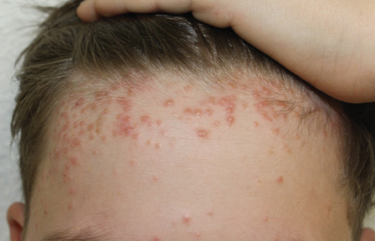 Figure 1. Monomorphic papules and pustules on an erythematous base located on the forehead and more densely clustered towards the scalp.