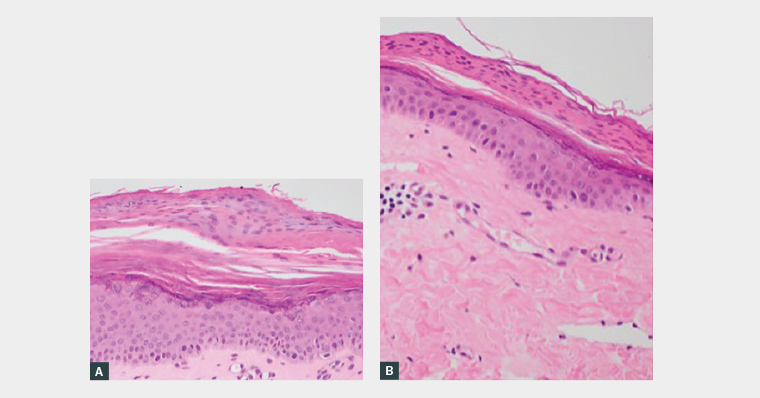 A skin biopsy from the groin rash demonstrated histological findings