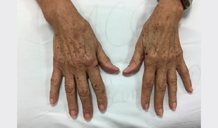 Figure 1. Vesicles and secondary milia noted on both hands