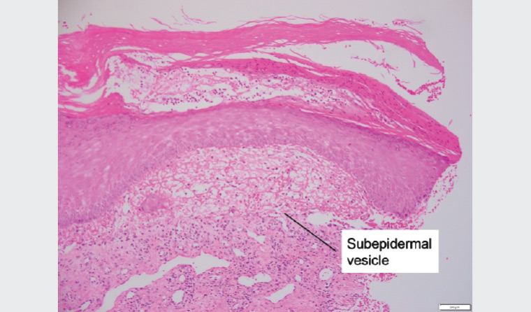 Figure 4. Haematoxylin and eosin staining of an excised lesion. The subepidermal vesicle, which contains sparse neutrophils and lymphocytes, is labelled