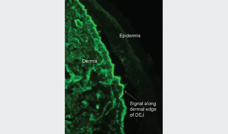 Figure 5. Immunofluorescence on salt-split skin testing showing linear immunoglobulin G along the dermal edge of the split