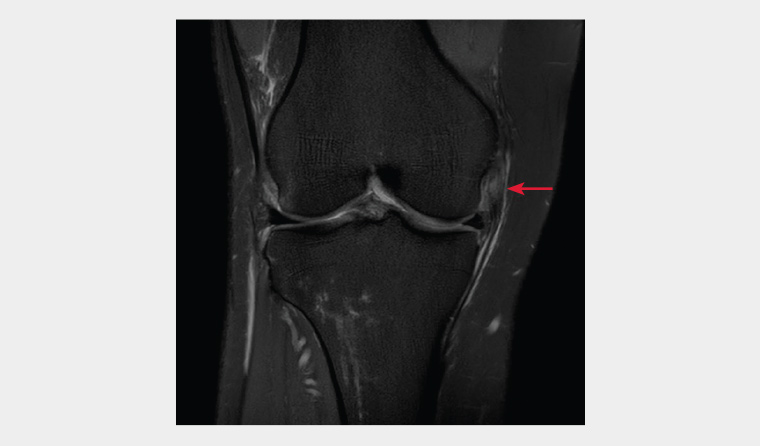 Proton-density, fat-suppressed, coronal magnetic resonance imaging reconstruction of the right knee demonstrating a partial thickness tear of the proximal medial collateral ligament (red arrow).