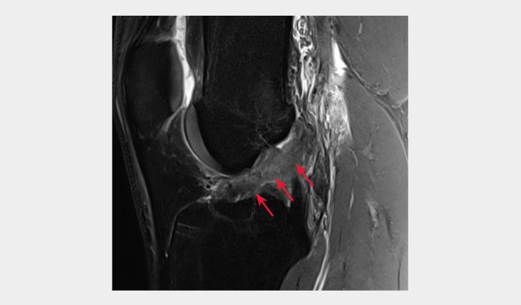 Proton density, fat suppressed, sagittal magnetic resonance imaging reconstruction of the left knee demonstrating a full thickness rupture of the anterior cruciate ligament (red arrows).