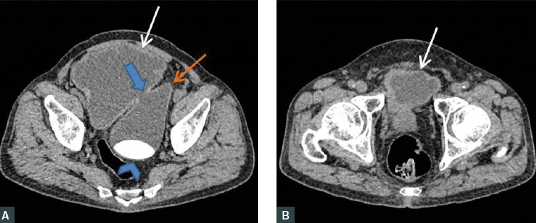 Figure 1. A. Axial contrast-enhanced computed tomography scan images showed the urinary bladder (white arrow) and the site of communication (blue arrow) with the outpouching cystic structure (orange arrow). A large radiopaque ovoid structure (blue arrowhead) was noted within the diverticulum. B. Axial contrast-enhanced computed tomography scan image inferiorly, showed the urinary bladder (white arrow) with thickened wall.