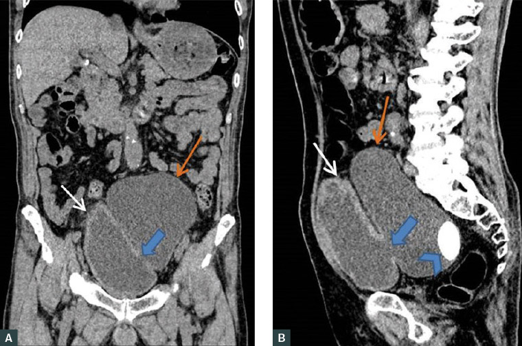 Figure 2. A. Coronal and B. sagittal contrast-enhanced computed tomography scan images showed a urinary bladder with a thickened wall (white arrow), the site of communication (blue arrow) with the large outpouching cystic structure (orange arrow) and a radiopaque structure (blue arrowhead) within the diverticulum.