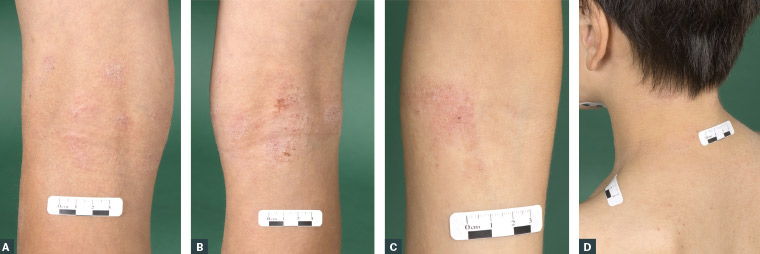 Figure 1. Atopic dermatitis presenting as lichenified, scaly, grey-to-pink plaques over the flexural surfaces of the knees (A, B), elbow (C) and back of the neck (D) in a boy with skin of colour.