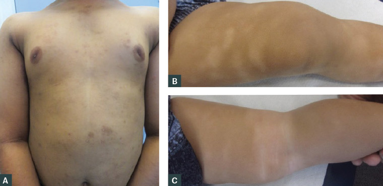 Figure 2. (A) Atopic dermatitis presenting with dark brown lesions in an Indian child. (B, C) Postinflammatory hypopigmentation following resolution of atopic dermatitis of the lower legs in an infant.