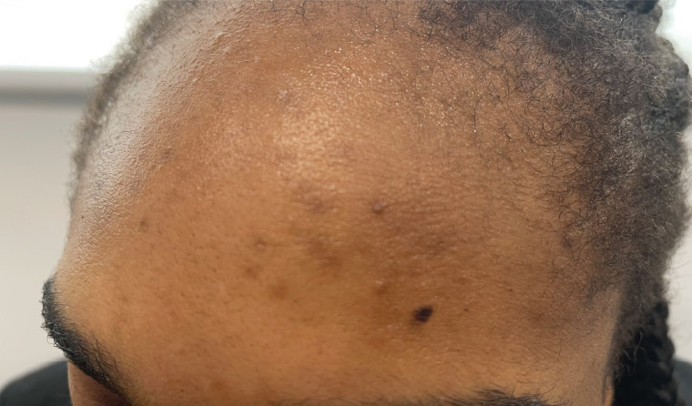 Figure 1. A 28-year-old woman of Nigerian ethnicity with hyperpigmented macules, papules and comedones over her forehead.