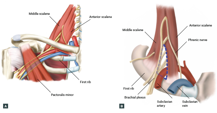 How to truly identify and treat thoracic outlet syndrome (TOS