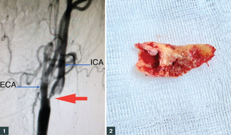 Figure 1. Ninety per cent stenosis in the proximal left internal carotid artery (red arrow). Figure 2. Removed plaque.