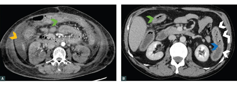 Axial computed tomography images of acute severe ulcerative colitis patients requiring an operation. These images highlight bowel wall thickening (green arrowhead), loss of haustral markings (white arrowheads), pseudopolyp extending into the lumen (blue arrowhead) and free intraperitoneal fluid (orange arrowhead).