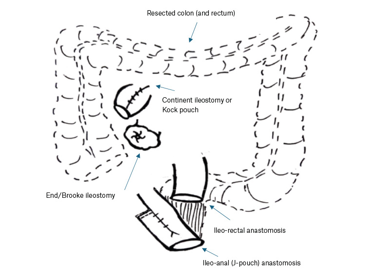 Original diagrammatic representation of surgical options for acute severe ulcerative colitis patients.
