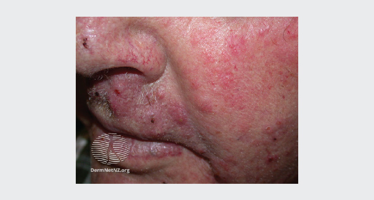 Tinea incognito on the face with more pustules, less scale and indistinct clinical borders.