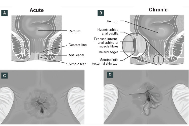 Figure 1. Coronal view of anal canal with acute anal fissure (A) and chronic anal fissure and sentinel tag (B). Lithotomy perineal view of acute anal fissure (C) and chronic anal fissure with sentinel tag (D).