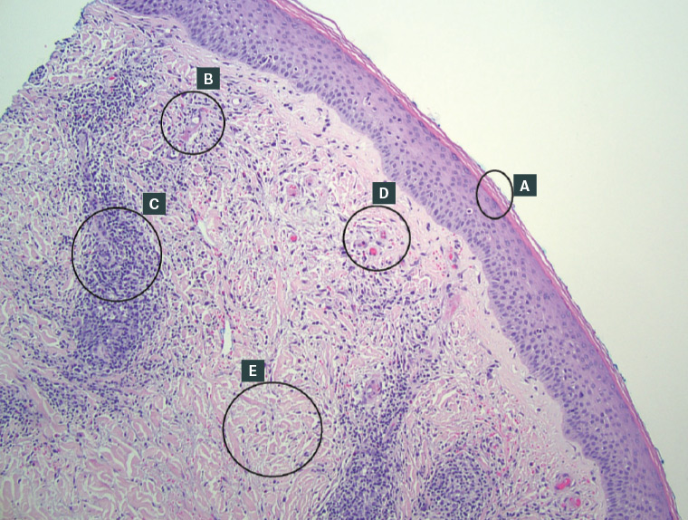 Figure 2. Histology of pretibial pruritic papular dermatitis. A. Compact orthokeratosis. B. Thickened blood vessel wall without vasculitis. C. Chronic perivascular inflammation. D. Congested blood vessels with extravasation. E. Dermal fibrosis with plump fibroblasts. (Haematoxylin and eosin stain, original magnification ×40.)