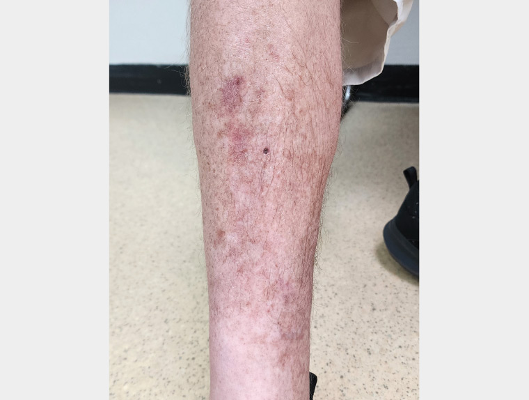 Figure 3. The right leg after 3 weeks of treatment.