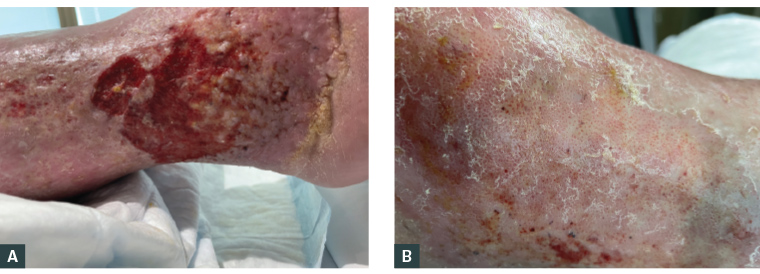 Figure 1. Legs at presentation. A. Ulcer over the right lateral malleolus demonstrating shallow erosion with irregular borders, surrounding haemosiderin deposition and lipodermatosclerosis. B. Left lateral malleolus venous dermatitis of the skin with atrophie blanche-like changes (depressed white areas with prominent red dots of dilated capillaries, often associated with moderate–severe pain).1
