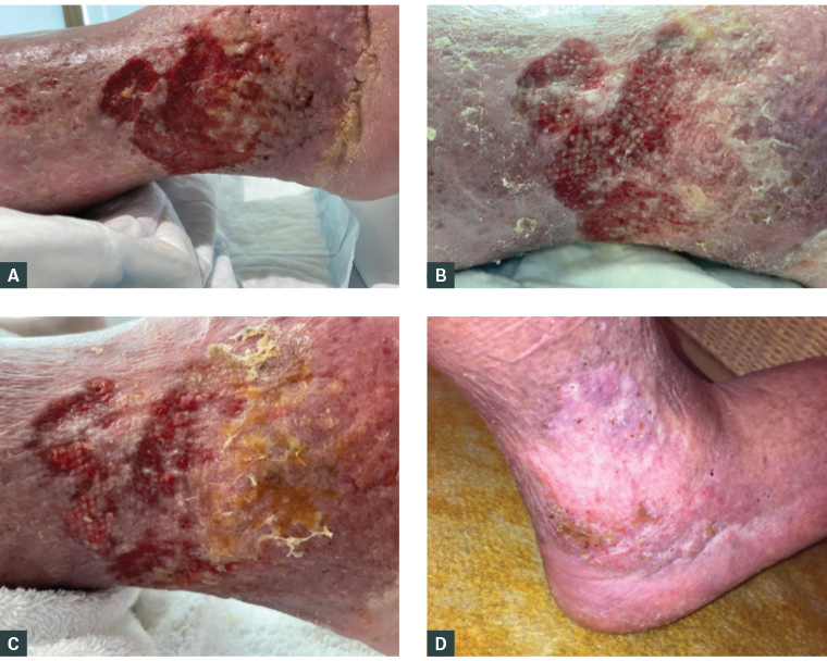 Figure 2. Right leg wounds following initiation of first-line principles. A. Day of admission. B. Day 12. C. Day 17. D. At the four-month review after discharge.