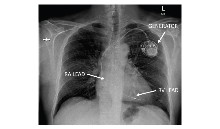 Racgp - Cardiac Implantable Electronic Devices