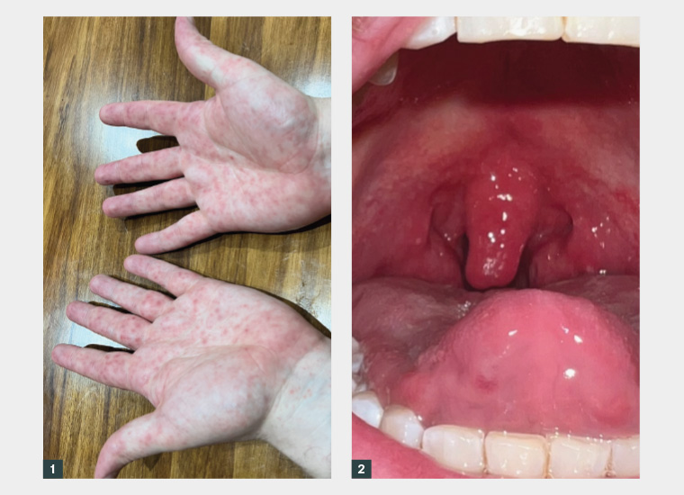 Figure 1. Mixed macular and vesicular hand lesions. Figure 2. Oedematous uvula and pharyngeal ulcers.