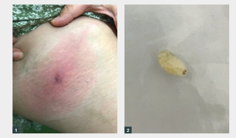 Figure 1. The thigh lesion in the woman aged 48 years.  Figure 2. The larva extracted from one of the lesions.