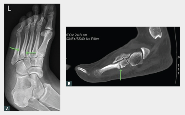 Figure 1. A. A preoperative X-ray of a non-union of a stress fracture to the fourth metatarsal