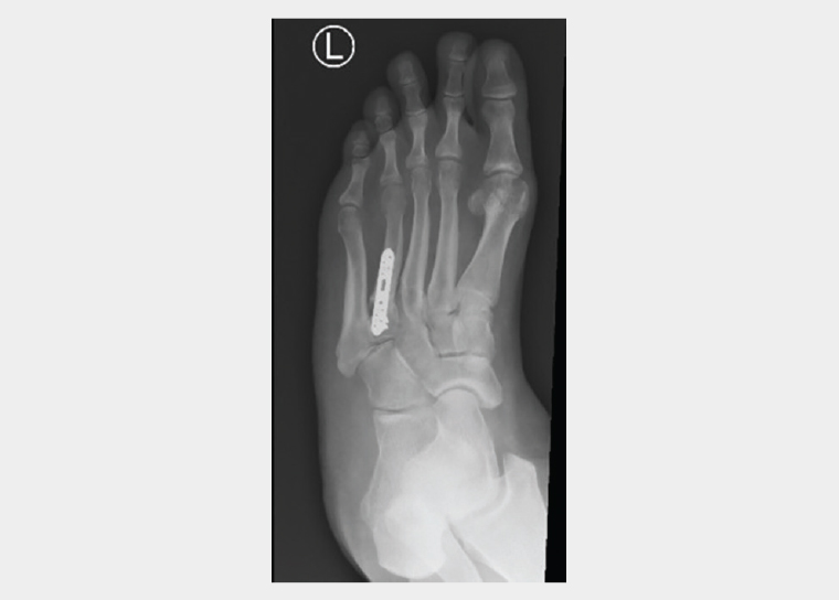 Figure 2. A postoperative X-ray of a successful union of the stress fracture shown in Figure 1