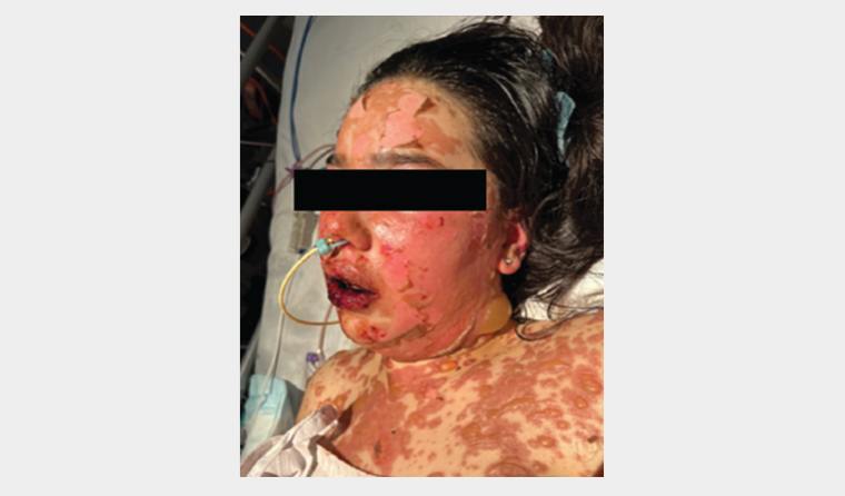 Figure 2. Day 5 of hospital admission. There is significant cutaneous desquamation and blistering on the face, neck and chest, along with severe haemorrhagic crusting on the lips. A nasogastric tube was inserted because the patient was unable to tolerate oral intake due to pain.