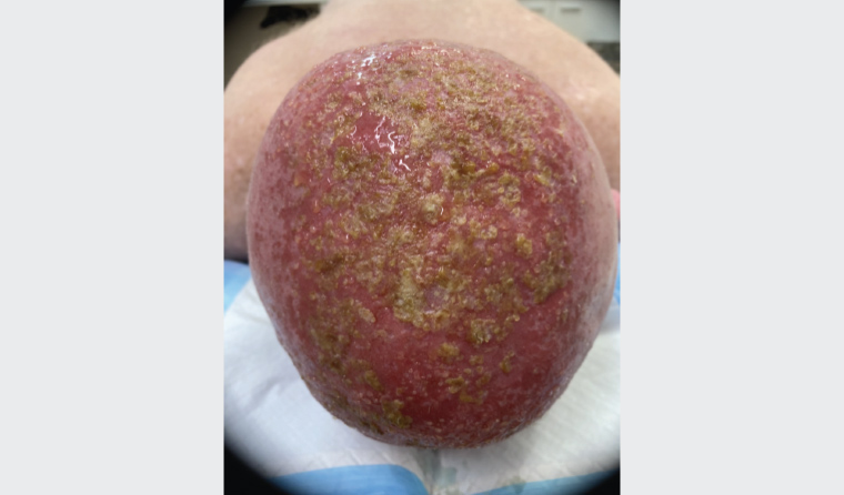 Figure 1. Scalp of a man aged in his 50s with a severe adverse reaction to 5-fluorouracil 5%25 cream, showing confluent erythema, oedema, crusting and lymphorrhoea. He had Olsen grade 2 solar keratoses on his scalp and had been applying the cream twice daily for the preceding eight days. He had previously used the cream without this reaction in the past. He was systemically well, with no fevers and minimal discomfort. Treatment was ceased and his scalp was managed with hygiene measures and twice daily methylprednisolone aceponate 0.1%25 fatty ointment. The patient was instructed to not use 5-fluorouracil 5%25 cream again, and went on to have daylight photodynamic therapy to treat his face, ears and neck, with a tolerable and moderate response.