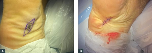 Figure 3. (A) An excisional biopsy with 2-mm margins. (B) Successful closure using a primary ellipse.