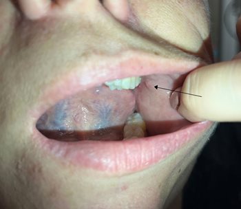 Figure 2. Stenson’s duct opening at the parotid papillae (note its position on the buccal mucosa opposite the second maxillary premolar).