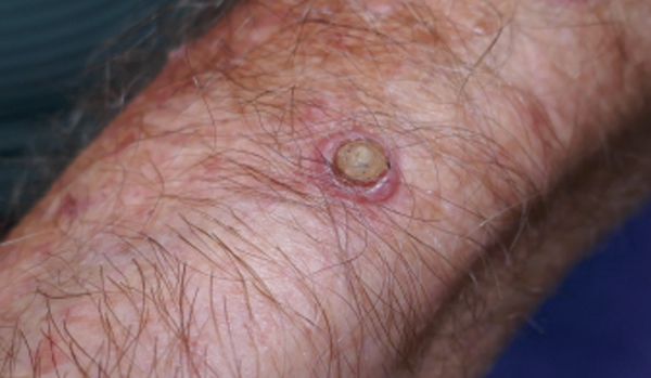 AJGP-0102-26-7648-CS-Frear-Keratin-Figure-1-WEB.jpg AJGP-0102-26-7648-CS-Frear-Keratin-Figure-1-WEB.jpg